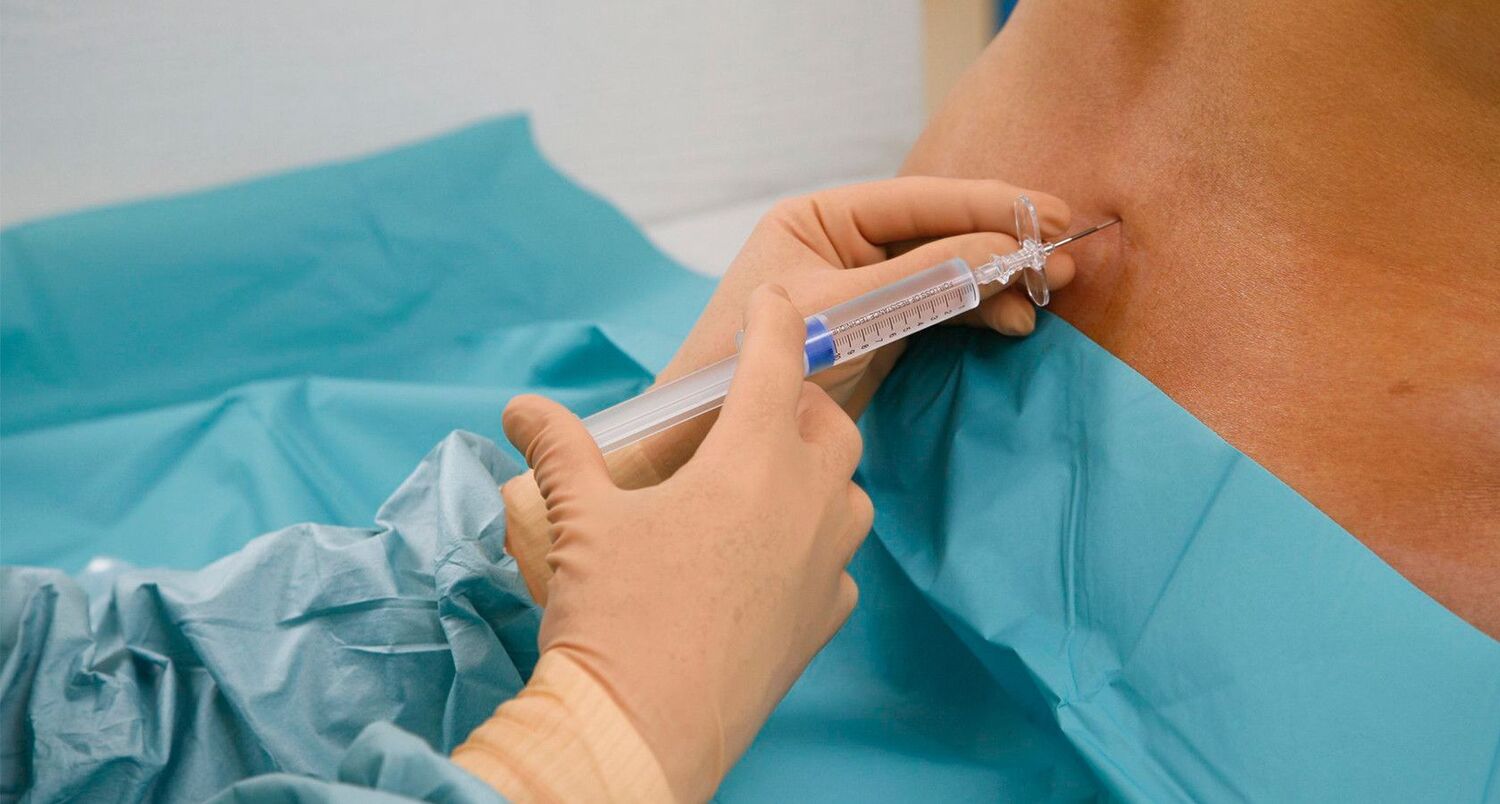 Блокада по Катлену